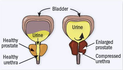 Medical diagram comparing a healthy prostate and urethra with an enlarged prostate compressing the urethra in BPH